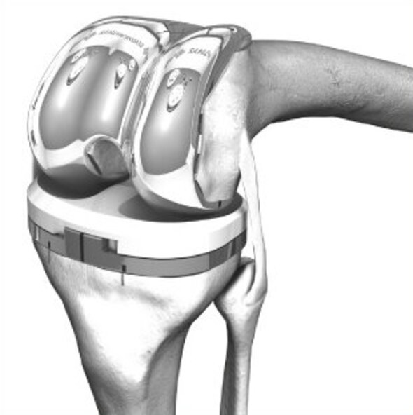 Die Prothese ist eingesetzt, das Knie wieder voll funktionsfähig