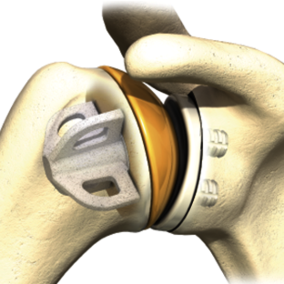 Implantierte Kurzschaftprothese und Glenoid