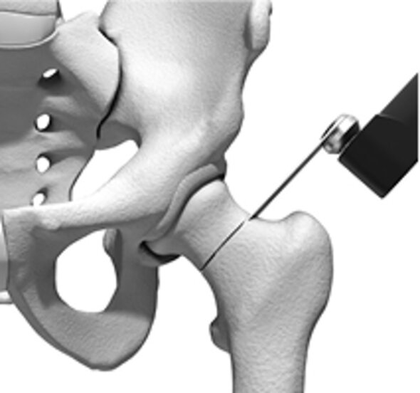 Entfernen der erkrankten Bereiche